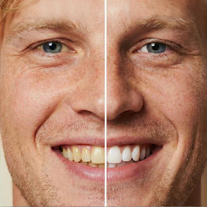 𝐈𝐧𝐬𝐭𝐚𝐧𝐭 𝐓𝐞𝐞𝐭𝐡 𝐖𝐡𝐢𝐭𝐞𝐧𝐢𝐧𝐠 𝐕𝐚𝐫𝐧𝐢𝐬𝐡 – 𝐁𝐫𝐢𝐠𝐡𝐭𝐞𝐫 𝐒𝐦𝐢𝐥𝐞